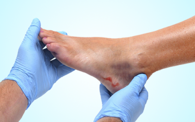 Cuidados del PIE DIABÉTICO