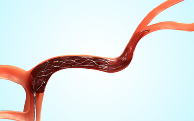 Tratamiento  Endovascular de las Várices